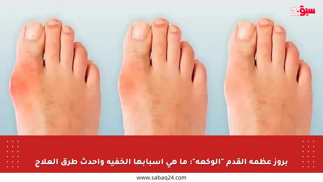 بروز عظمة القدم “الوكعة”: ما هي أسبابها الخفية وأحدث طرق العلاج